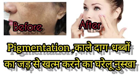 Pigmentation छाया काले दाग धब्बे को जड़ से हटाने का घरेलु नुस्खा । 1