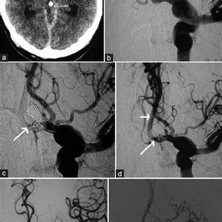 CT scan shows subarachnoid hemorrhage predominantly in the anterior ...