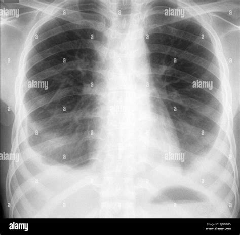 Pleural Effusion X Ray Stock Photo Alamy