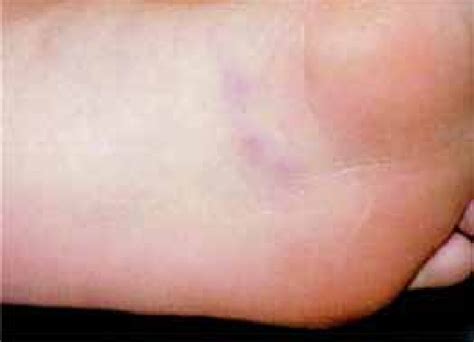 Palmoplantar Eccrine Hidradenitis Painful Erythematous Papules And