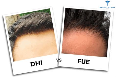 DHI Vs FUE Hair Transplant Procedures Medical Center Turkey