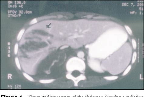 Figure 1 From Outcome Of Nonoperative Management Of Blunt Liver Trauma