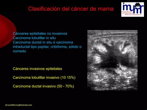 Lesiones Benignas Y Malignas De La Mama Por Ultrasonido Dr Romel