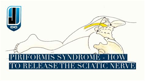 Chiropractic Treatment For Piriformis Syndrome Jason Williams Dc