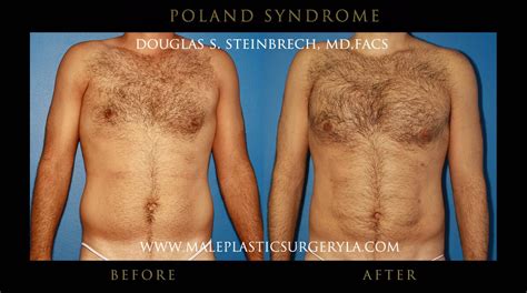 Poland Syndrome Before After Gallery Male Plastic Surgery Los Angeles