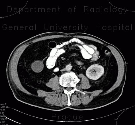 Radiology Case Mucocoele Of Appendix