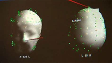 What Is Tbs Theta Burst Stimulation Tms Center Of Ventura