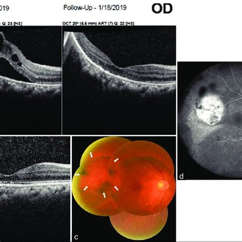 A 16 Days After Aflibercept Injections Marked Resolution Of Cystoid