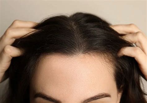 Female Hair Transplant In Riyadh