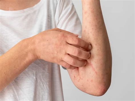 Alpha Gal Syndrome Ags Or Red Meat Allergy Causes And Symptoms