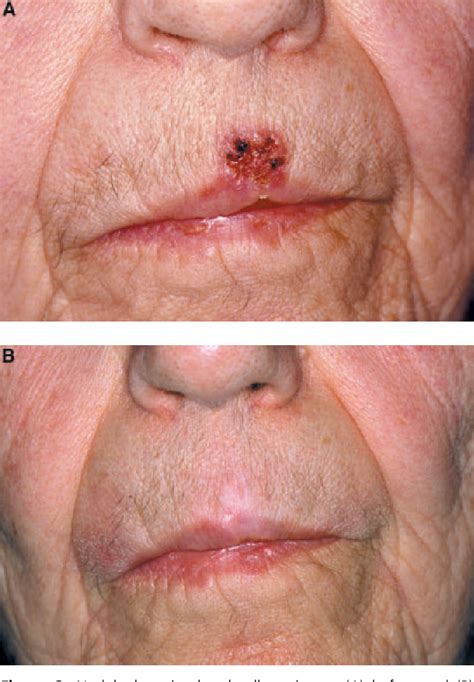 Figure 1 From Imiquimod Treatment Of Superficial And Nodular Basal Cell Carcinoma 12‐week Open