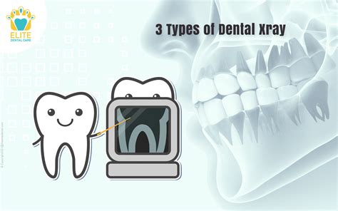 Types Of Dental Xray Elite Dental Care