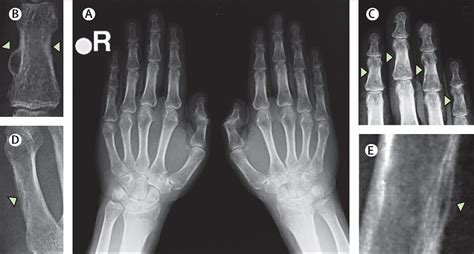 Osteitis Fibrosa Cystica Brown Tumor