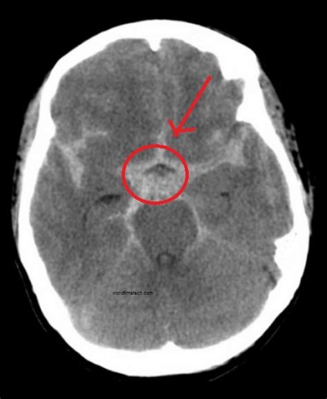 Subarachnoid Hemorrhage Headache Symptoms Treatments Causes