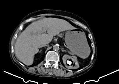 Emphysematous Pyelonephritis Image Radiopaedia Org