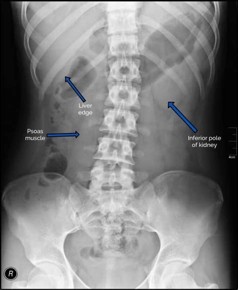 Visible Structures Abdomen Xr Psoas Muscle Radiology X Ray Liver