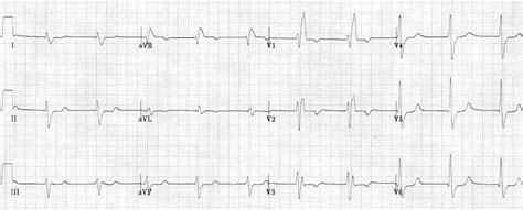 Right Bundle Branch Block Symptoms