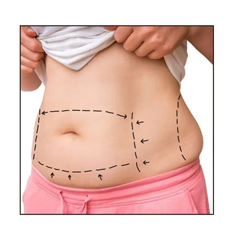 Abdominoplastie Tunisie Chirurgie Du Ventre Tablette De Chocolat