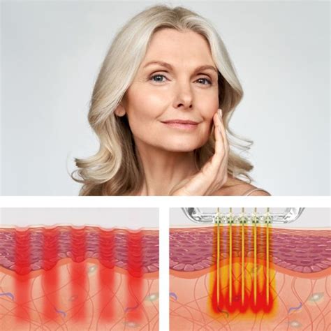 Secret Rf Sydney The Ultimate Microneedling Treatment