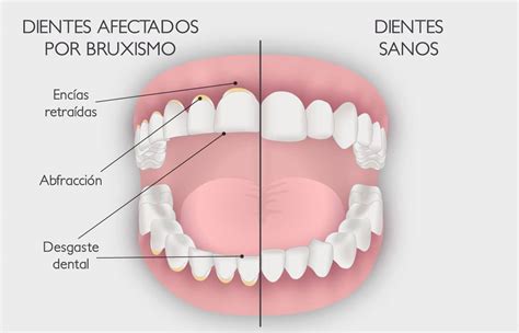 Bruxismo Principales Síntomas Y Tratamiento Periodontium