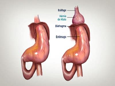 Puede Desaparecer Una Hernia De Hiato Dr Jes S Mart Nez Hoed