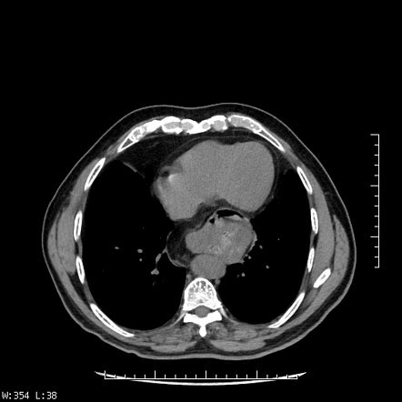 Sliding Hiatus Hernia Radiology Case Radiopaedia Org