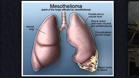 Call Shrader Associates LLP If You Have Mesothelioma From Asbestos