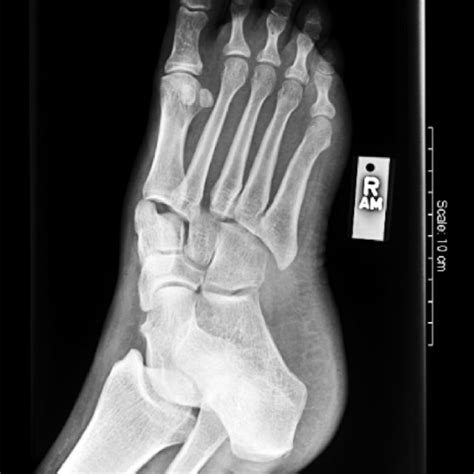 Lisfranc Fracture Dislocation Pre Reduction Radiograph Oblique View Download Scientific