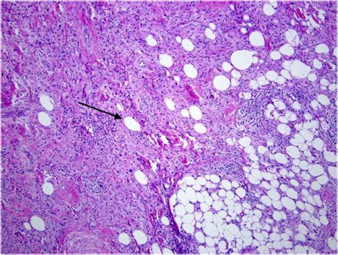 Incidental Dedifferentiated Mediastinal Liposarcoma On F