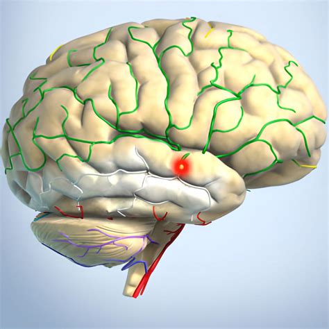 Animation stroke - MedicalGraphics