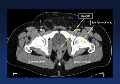 Ct Anatomy Pelvis Muscles Presentation1 Pptx Ct Normal Anatomy Of The