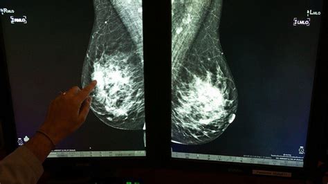 Researchers Identify Possible New Risk For Breast Cancer The New York Times