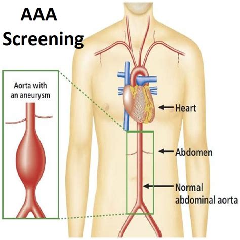 Abdominal Aortic Aneurysm Screening Test Aaa Visit Our Specialist 12 11 2021 Clinica