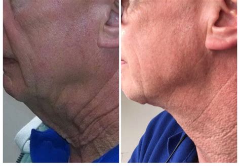 Best Neck Lift In Long Island Platysmaplasty By Dr Doshi