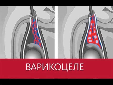 Варикоцеле - YouTube
