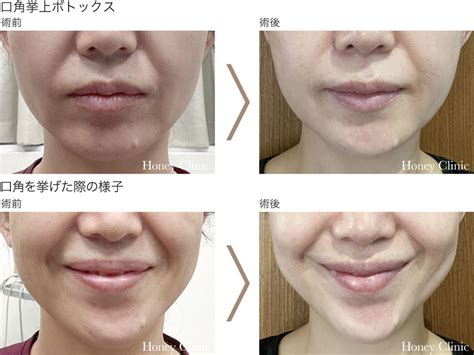 しわ・たるみ ボトックス ハニークリニック 熊本の美容外科、エイジングケア・アートメイク・脱毛・薄毛治療