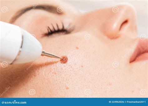 Electrocoagulation And Laser Cosmelotogy Dermatologist Using A