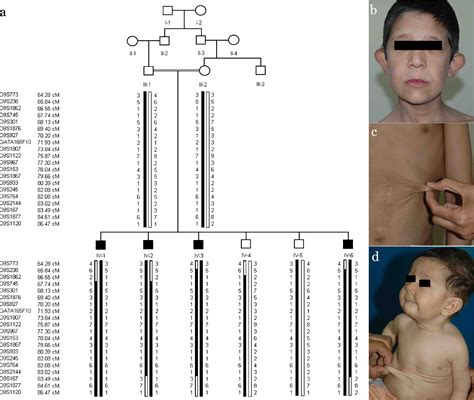 Congenital Cutis Laxa Syndrome Maps To A Novel Locus On Chromosome Q