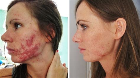 Accutane for Acne Treatment - Zel Skin & Laser Specialists - now Schweiger Dermatology Group ...