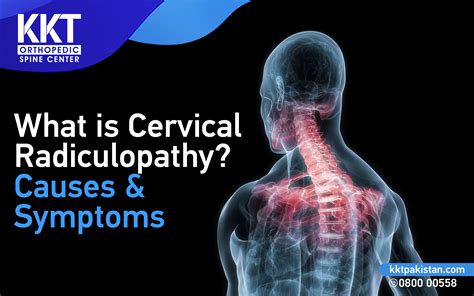 What Is Cervical Radiculopathy Causes And Symptoms Kkt Pakistan