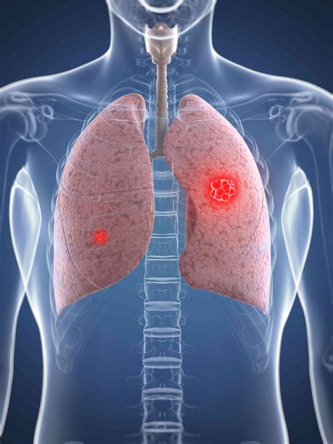 Trastornos de la cavidad pleural Medicina Básica