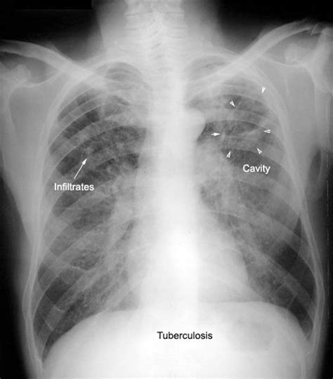 Tuberculosis X Ray Cavitation