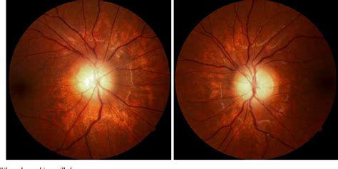 Figure 1 From Pseudotumor Cerebri Associated With Leuprolide Acetate For Central Precocious