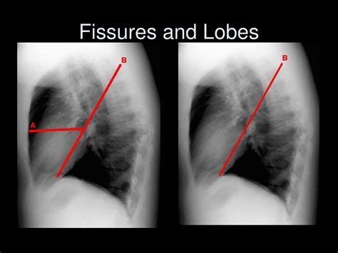 Ppt The Complete Idiot’s Guide To Reading The X Ray Powerpoint Presentation Id 583063