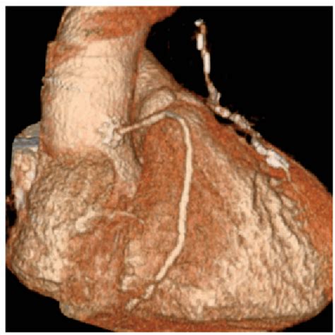 Figure From Non Invasive Imaging Of Sutureless Vein Graft Anastomosis