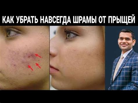Следы От Прыщей Затягиваются Очень Быстро? - YouTube