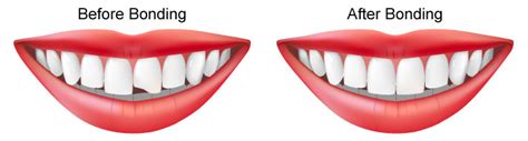 What Is A Cosmetic Bonding Teeth Royal Dental Clinics Blog