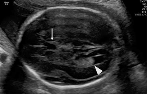 Normal Fetal Brain Ultrasound