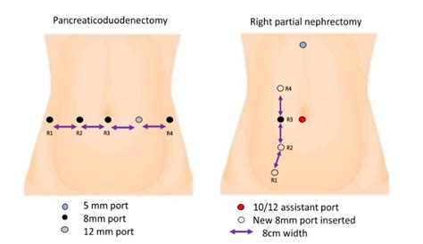 Modified Transperitoneal Ports Configuration Technique And Docking With