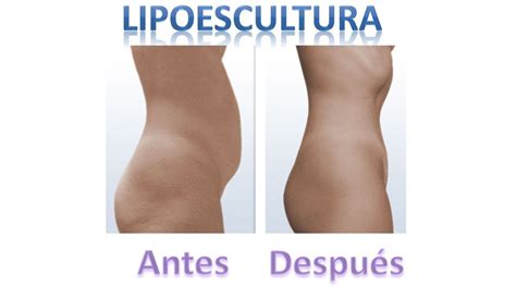 Lipoescultura Laser Y Tradicional Con Fotos De Antes Y Despues Y